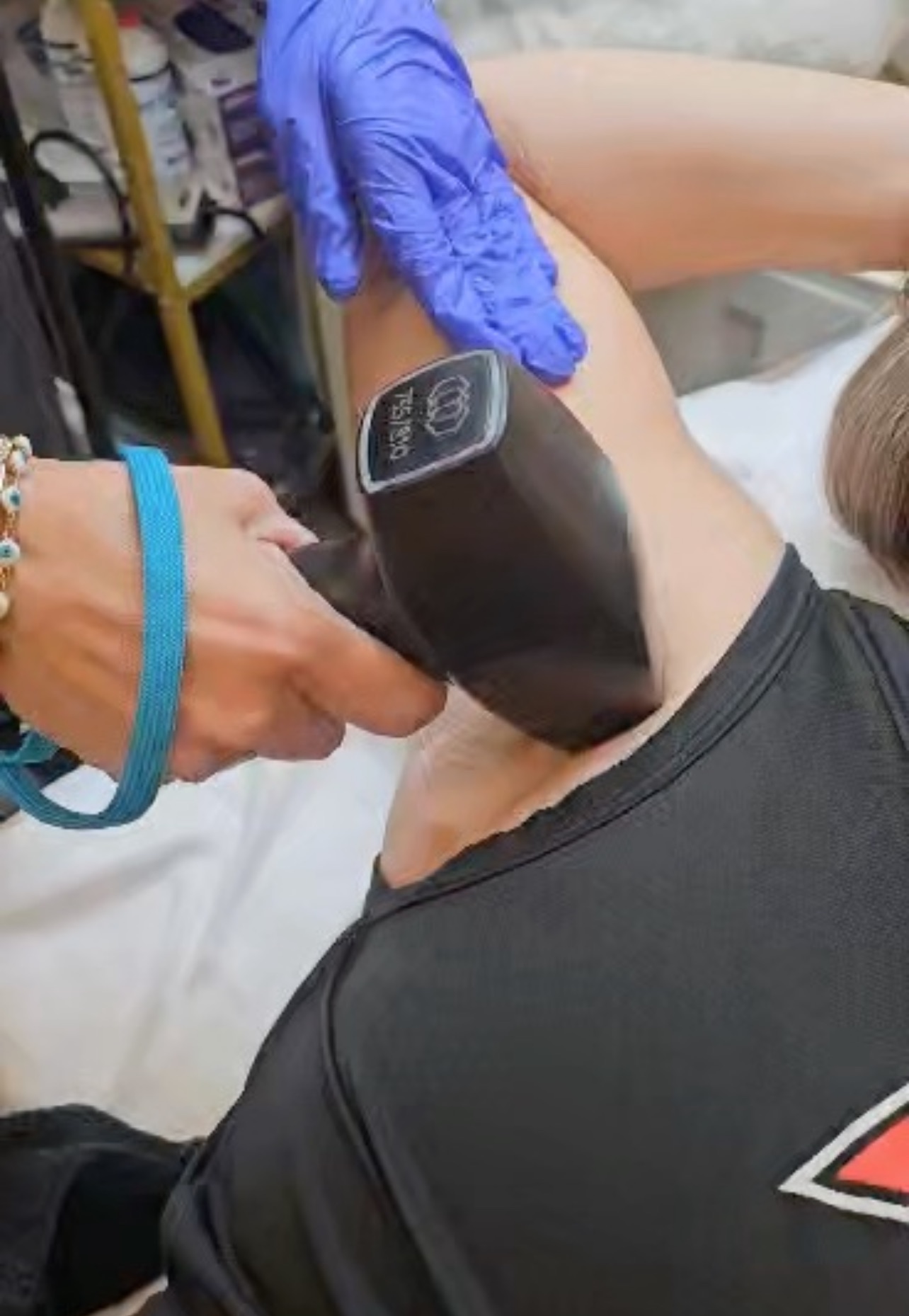 Laser Hair Removal