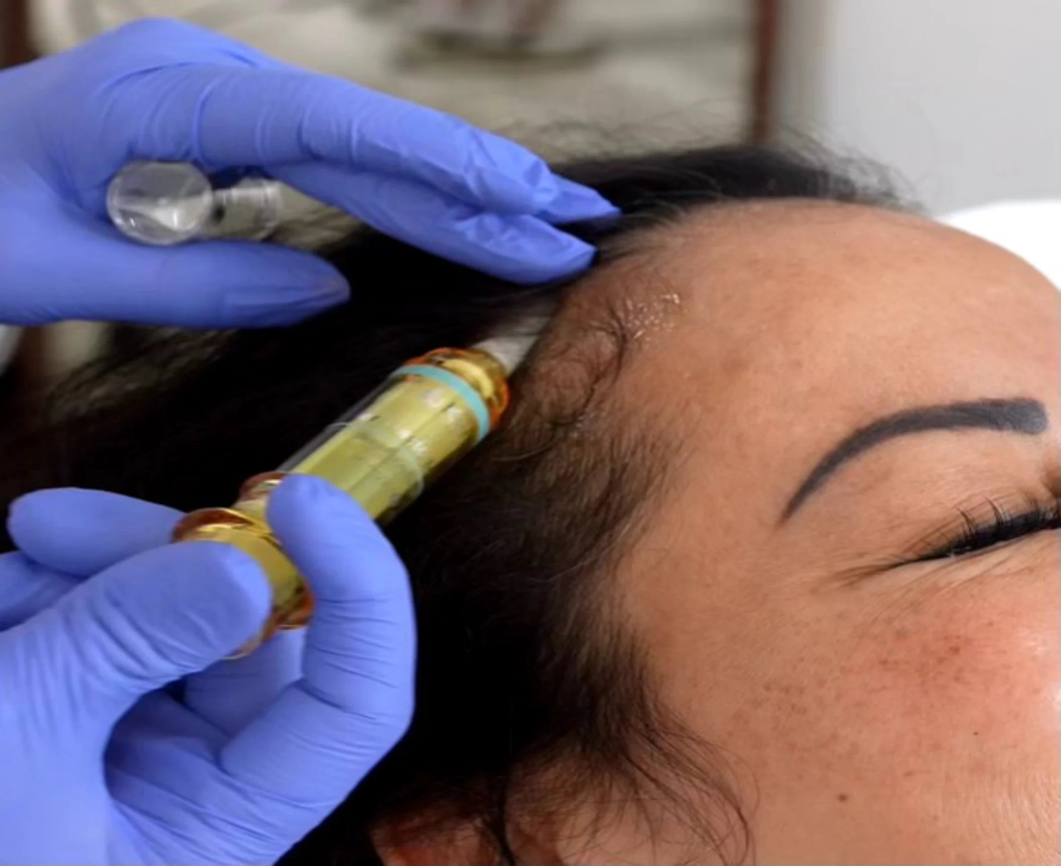 A close-up of a woman receiving a hair restoration treatment, with a syringe applying solution near her hairline